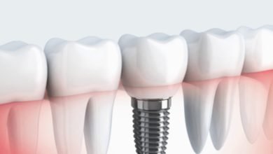 dental implant cost London