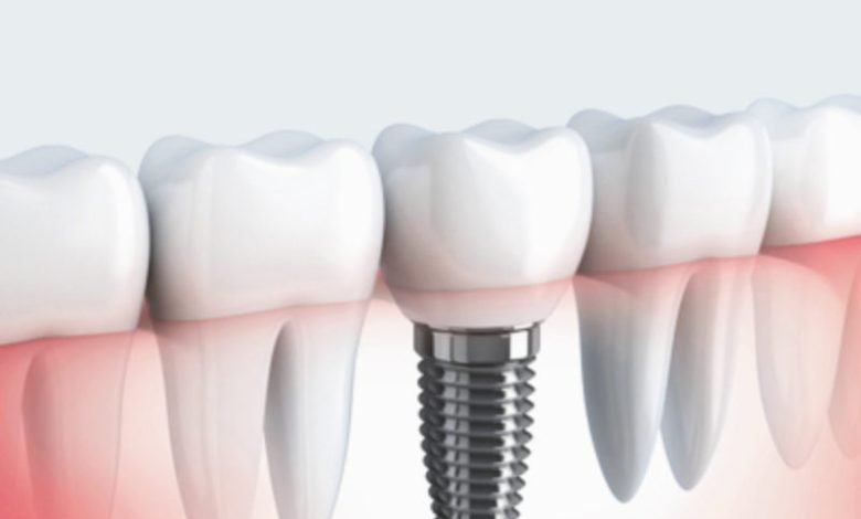 dental implant cost London
