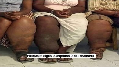 Filariasis