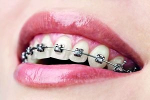 dental implant London