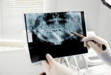 Dental X-Rays