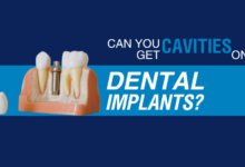 dental implants