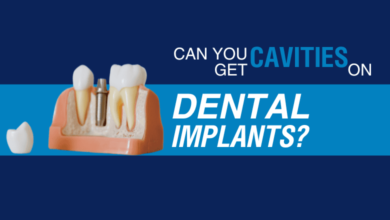 dental implants