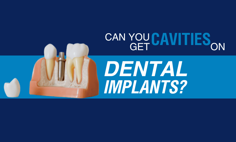 dental implants