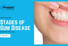 stages of gum disease