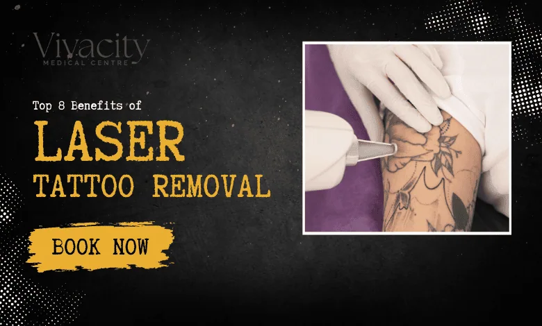 laser tattoo removal