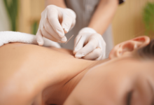 Licensed practitioner performing acupuncture on a patient’s upper back using sterile needles in a clinical wellness setting.